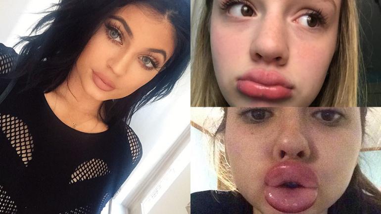 Aftermath of the Lip Challenge 