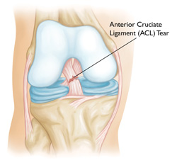 Torn ACLs: The scare of playing high school sports