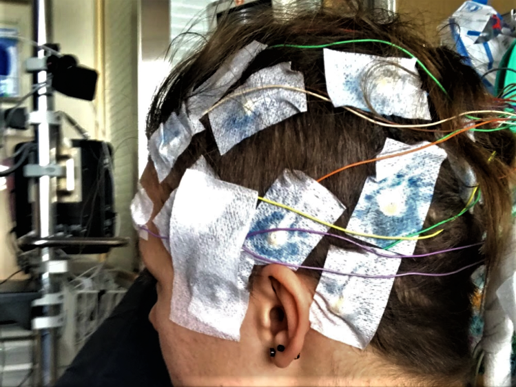 Electrodes glued to my head for five days in a test called an EEG